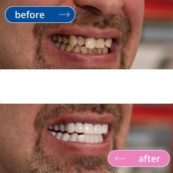 لمینت دندان دو فک مدل TruSmile به همراه نوار چسب سفیدکننده دندان